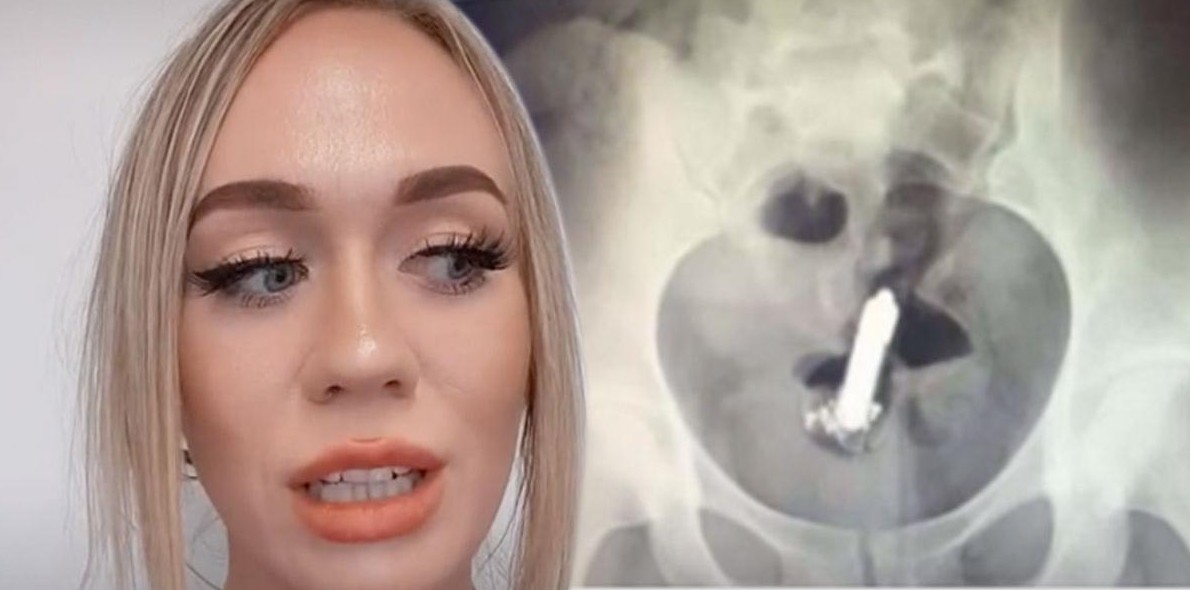 У девушки в заднице застрял вибратор и работал всю ночь - «Клуб - Юмора»