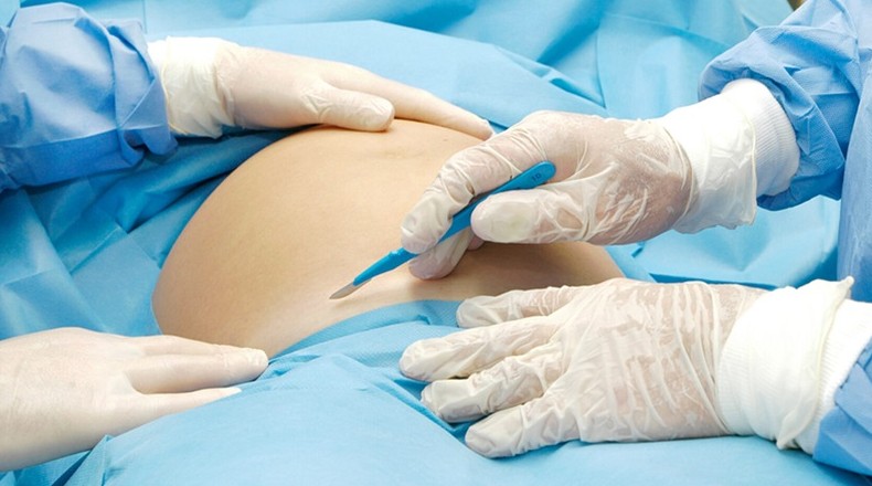 Почему кесарево сечение так называется - «Клуб - Юмора»