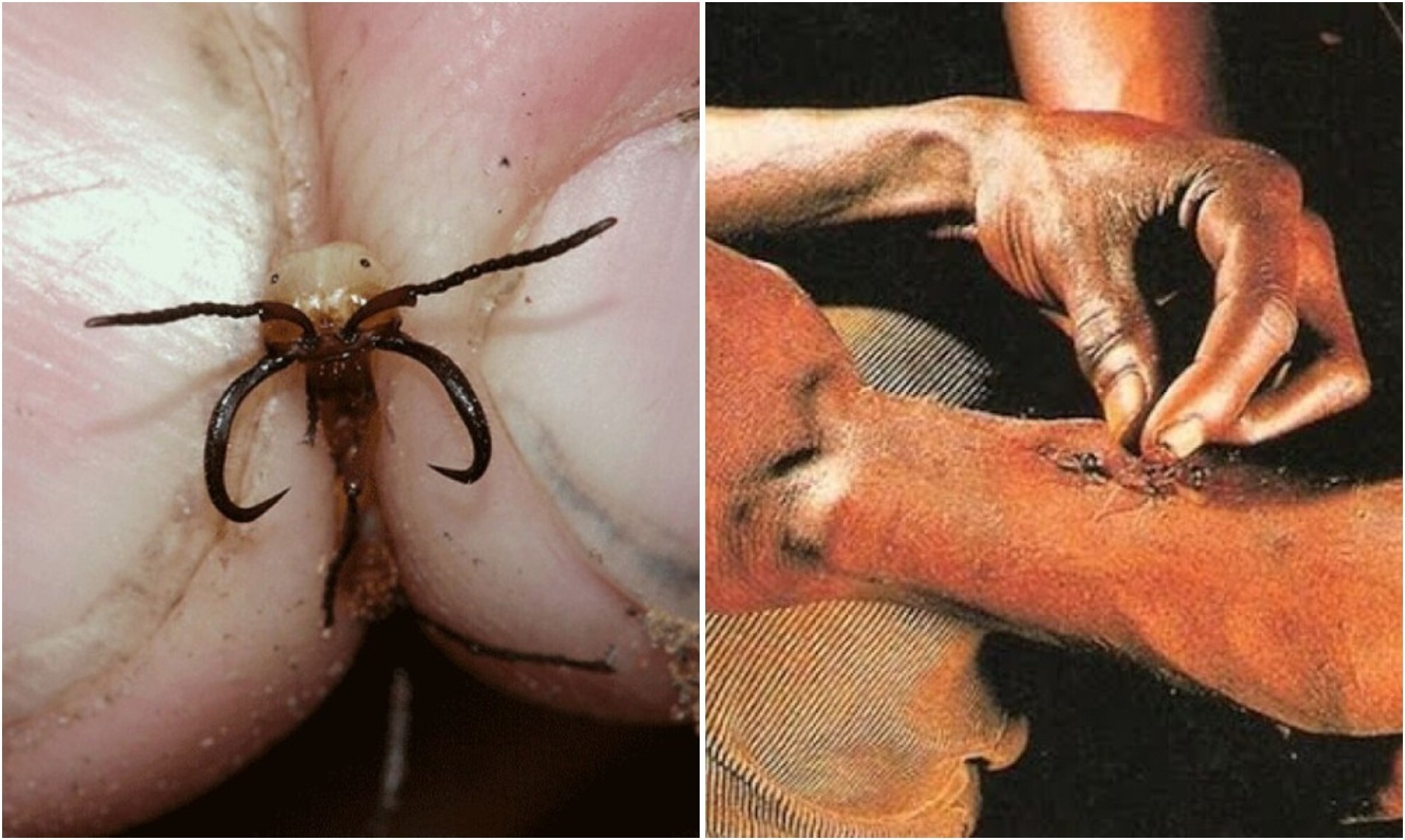 Как муравьёв используют в качестве хирургического шва - «Клуб - Юмора»