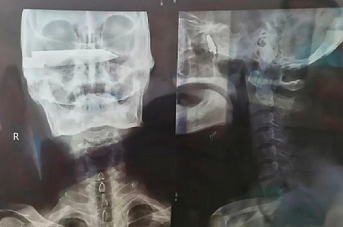 Мужчина прожил 26 лет с лезвием ножа в голове - «Клуб - Юмора»