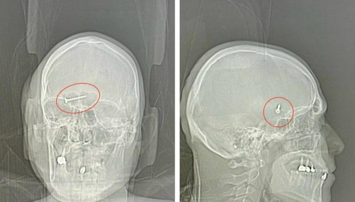 Хирурги достали из головы мужчины саморез и резиновый шарик - «Клуб - Юмора»