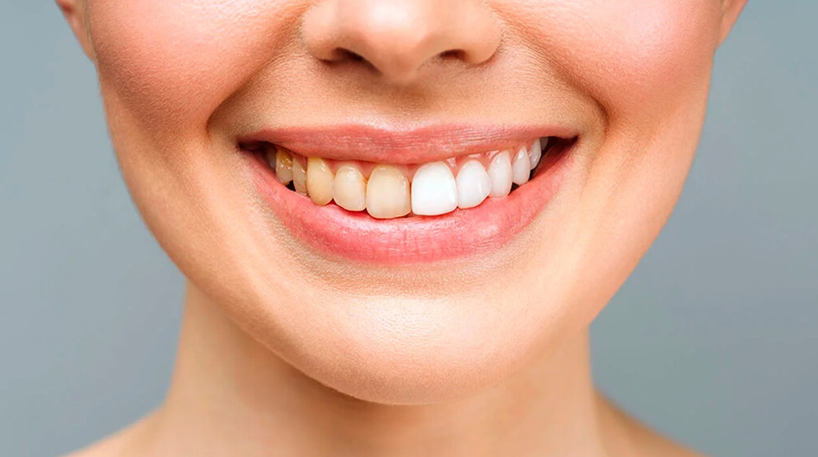 Почему темнеют зубы - «Клуб - Юмора»